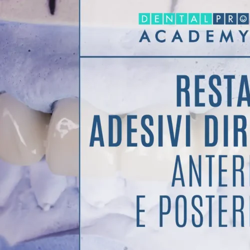 Restauri adesivi diretti anteriori e posteriori